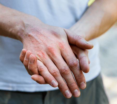 Alergiczne zapalenie skóry – objawy i sposoby leczenia