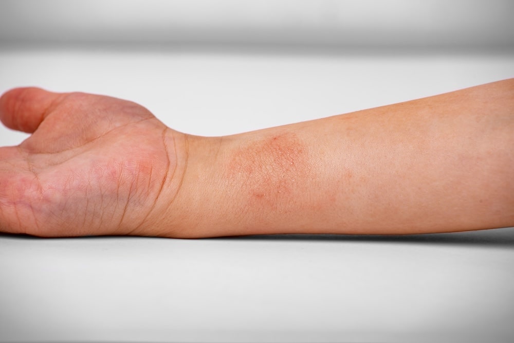 AZS na ręce dziecka