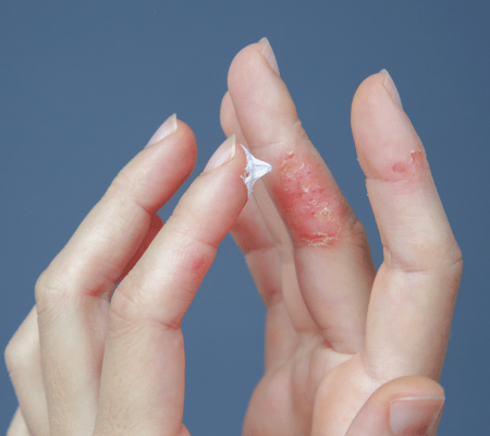 Diagnostyka atopowego zapalenia skóry – proces, testy, badania na AZS