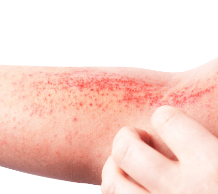 Innowacje terapeutyczne w leczeniu atopowego zapalenia skóry