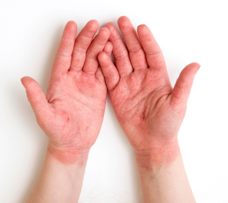 Jak rozpoznać i leczyć atopowe zapalenie skóry? Samodzielna diagnoza